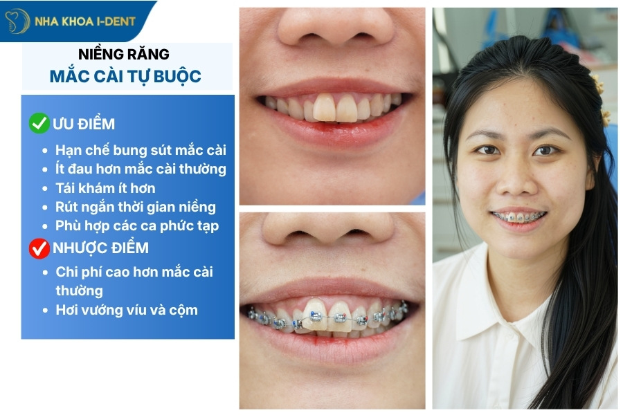niềng mắc cài