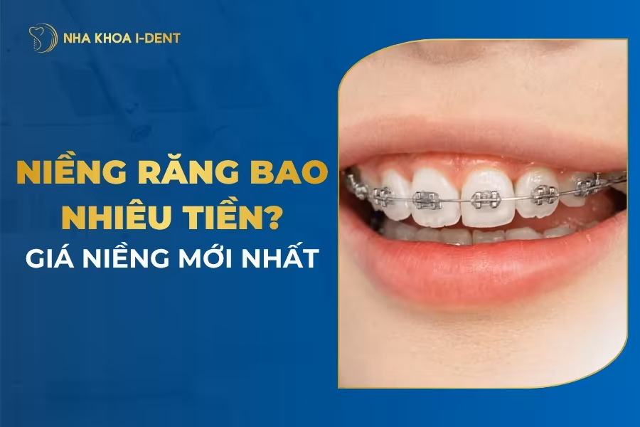Niềng Răng Giá Bao Nhiêu? Giá Mới Nhất