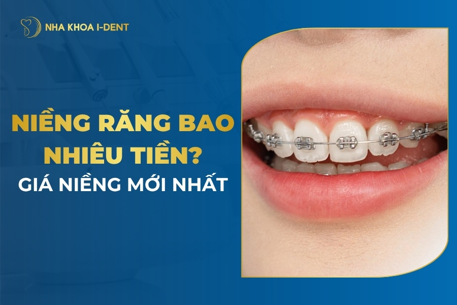 Niềng Răng Giá Bao Nhiêu? Giá Niềng Mới Nhất [Tháng 4/2026]