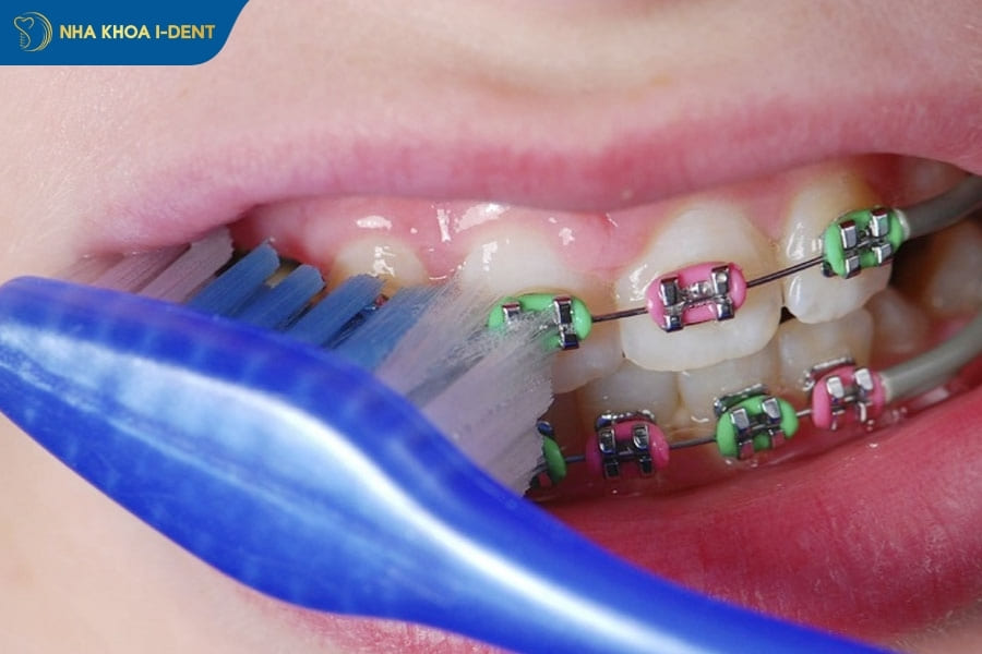 bị tụt lợi khi niềng răng