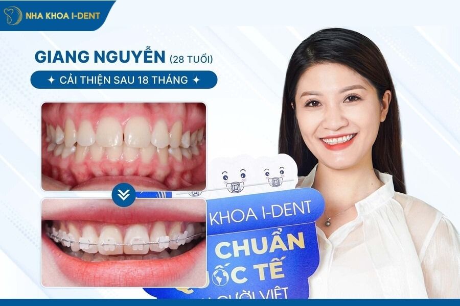 thời gian niềng răng cho người lớn