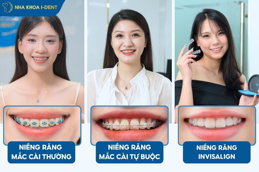niềng răng có cải thiện mặt lệch không