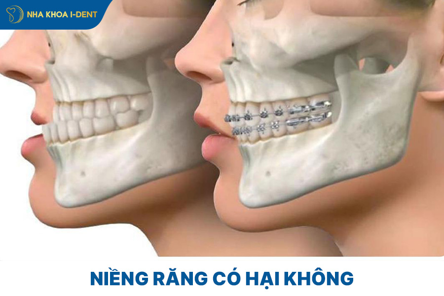 niềng răng có hại gì không