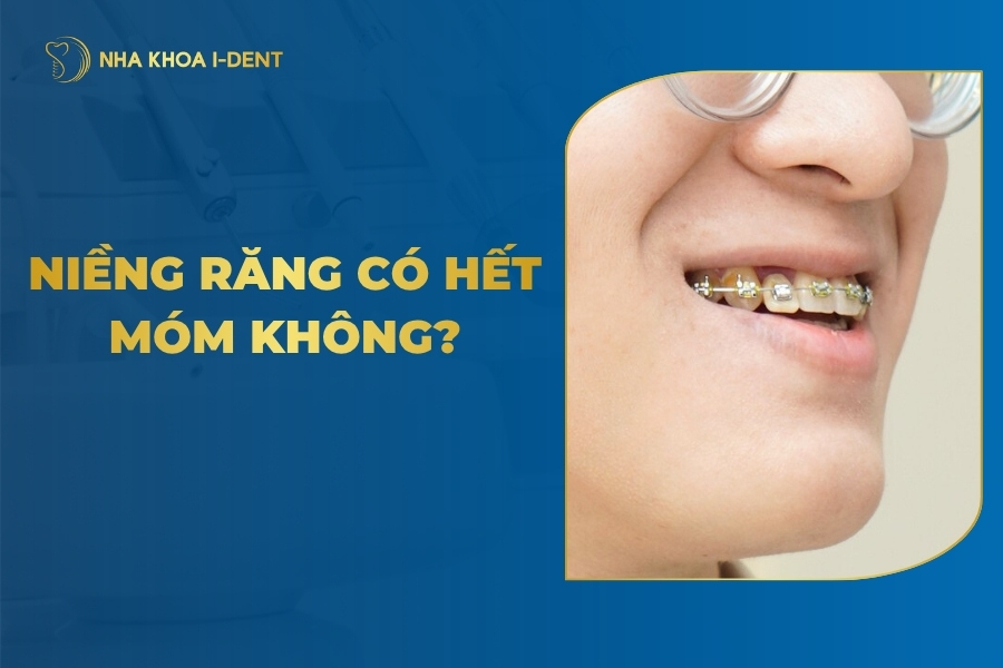 Niềng răng có hết móm không? Bao Lâu Hết?