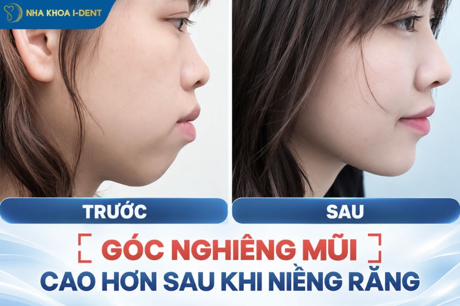 niềng răng có làm thay đổi khuôn mặt không