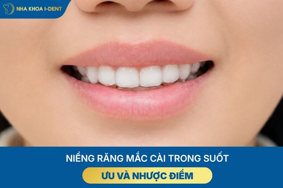 niềng răng có mấy loại