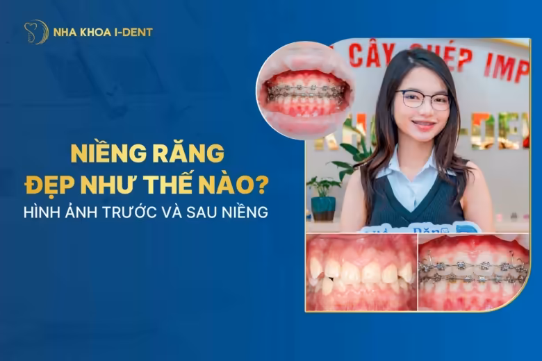 Niềng răng đẹp như thế nào? Hình ảnh trước và sau niềng
