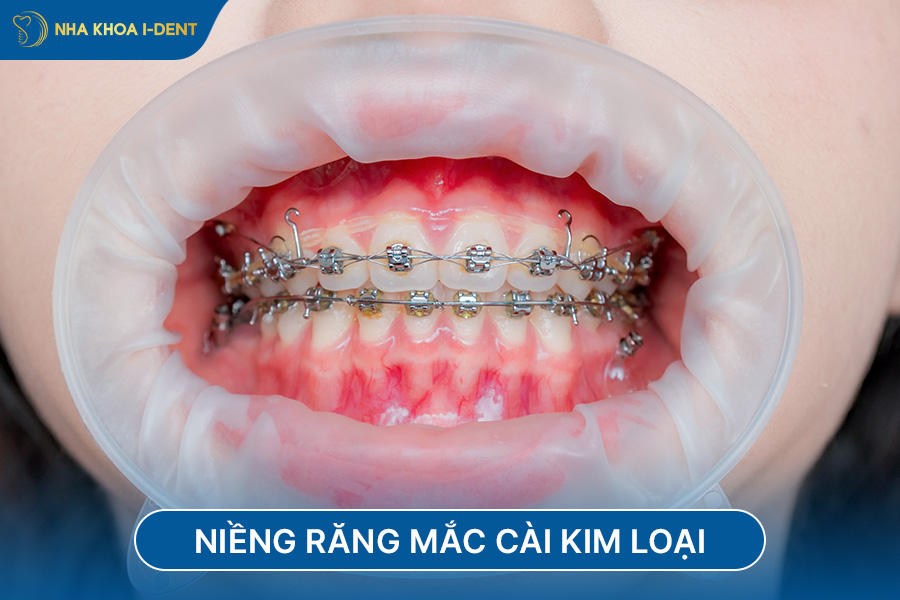 Niềng răng mắc cài kim loại