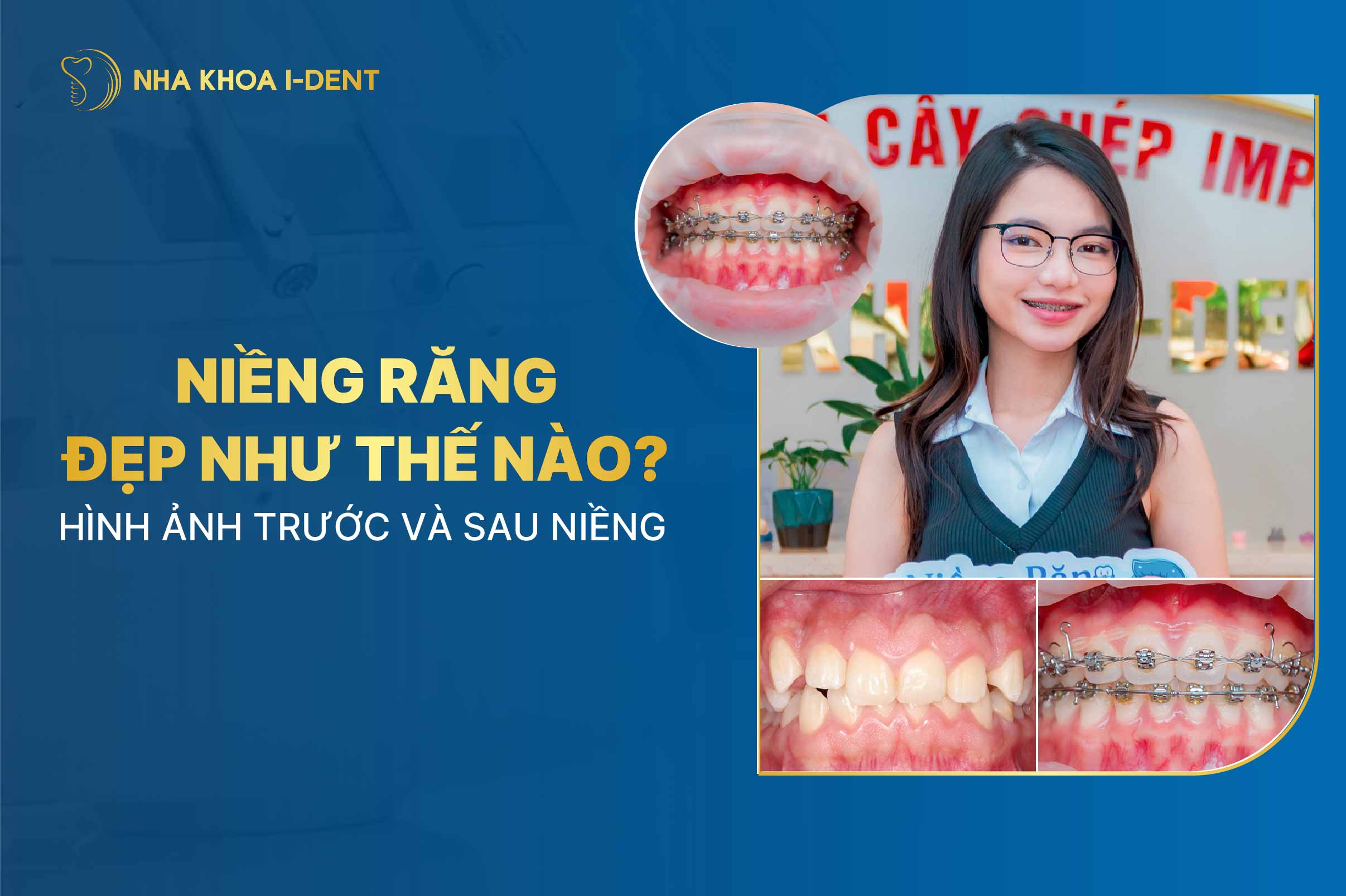 Niềng răng đẹp cỡ nào? Hình ảnh trước và sau khi niềng