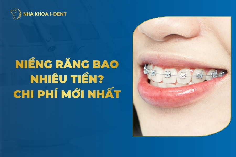 [Tháng 3/2026] Niềng Răng Giá Bao Nhiêu? Chi Phí Mới Nhất