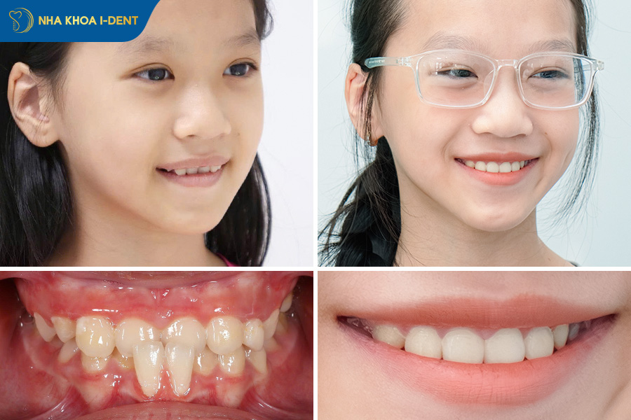 niềng răng hết móm