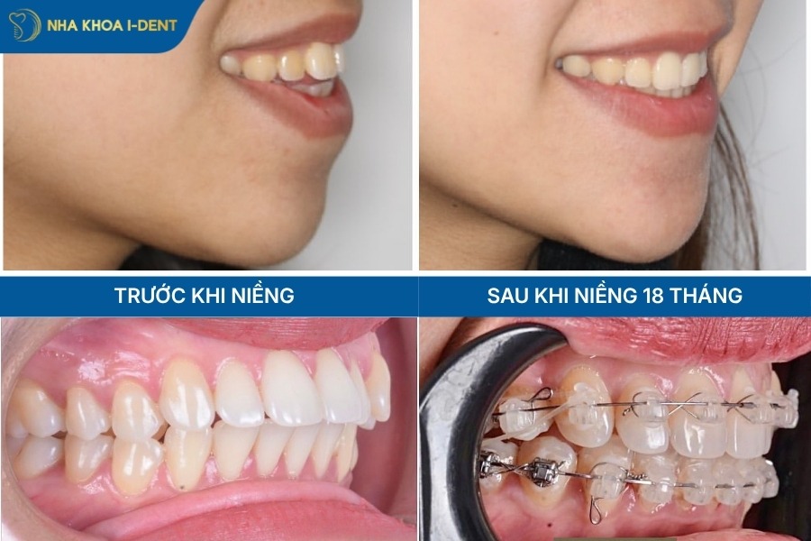 hô hàm có niềng được không