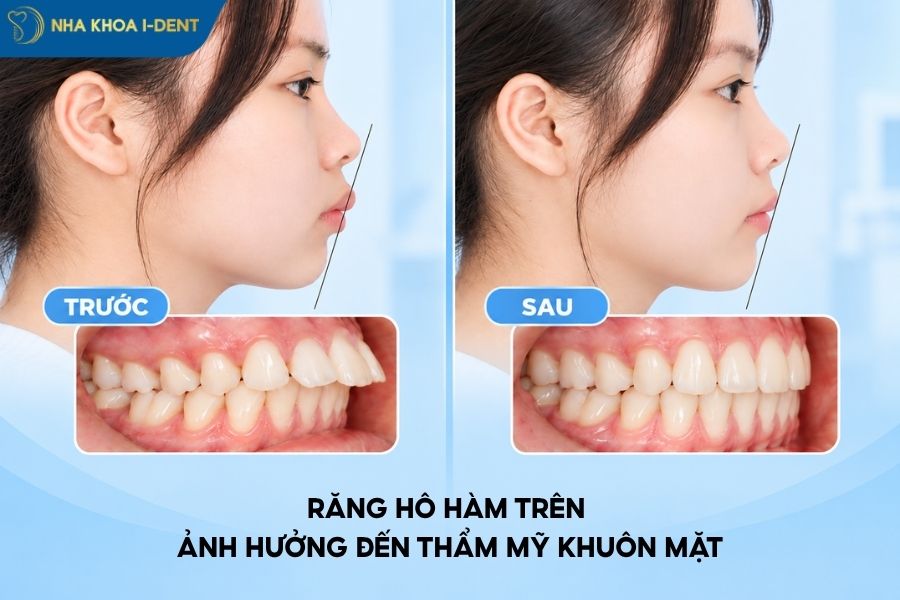 niềng răng hô hàm