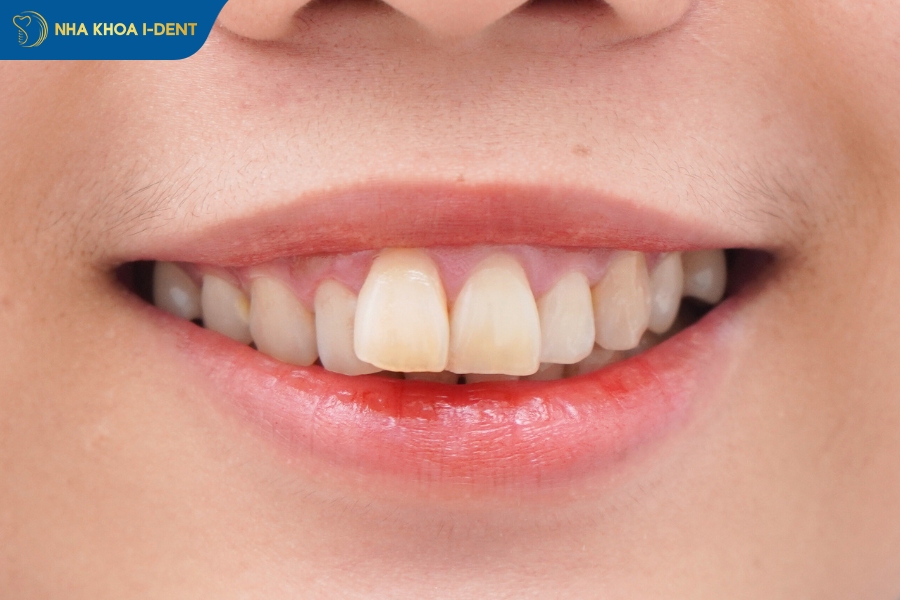 niềng răng hô nhẹ có phải nhổ răng không