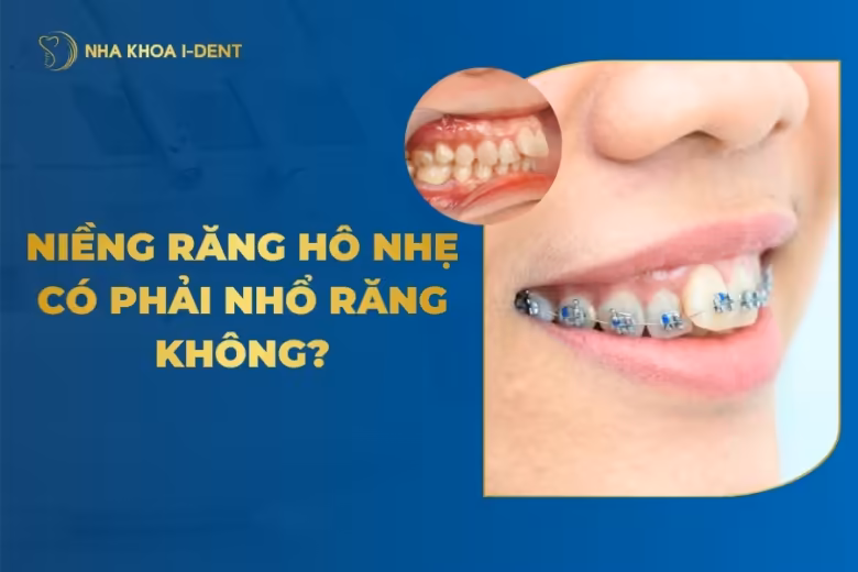 niềng răng hô nhẹ có phải nhổ răng không