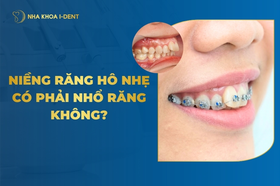 Niềng răng hô nhẹ có phải nhổ răng không? Khi nào cần?