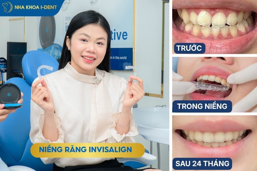 niềng răng không mắc cài - nieng-rang-khong-mac-cai-invis