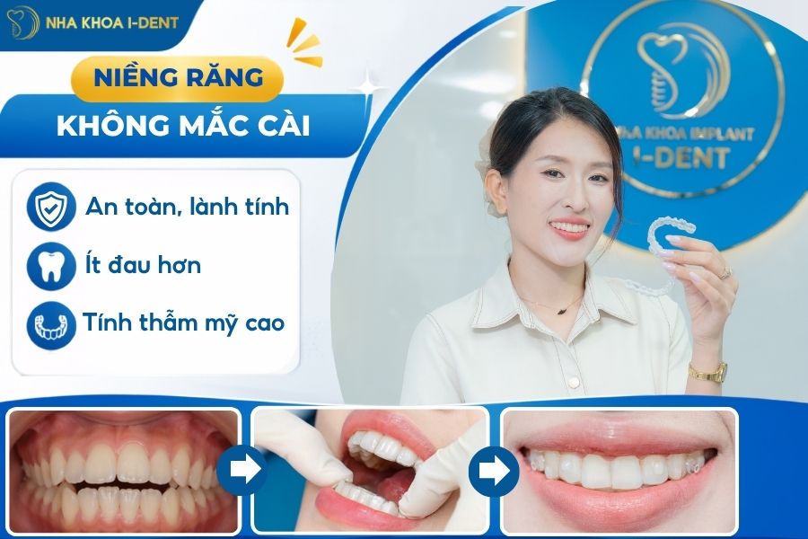 niềng răng không mắc cài - nieng-rang-khong-mac-cai-la-gi