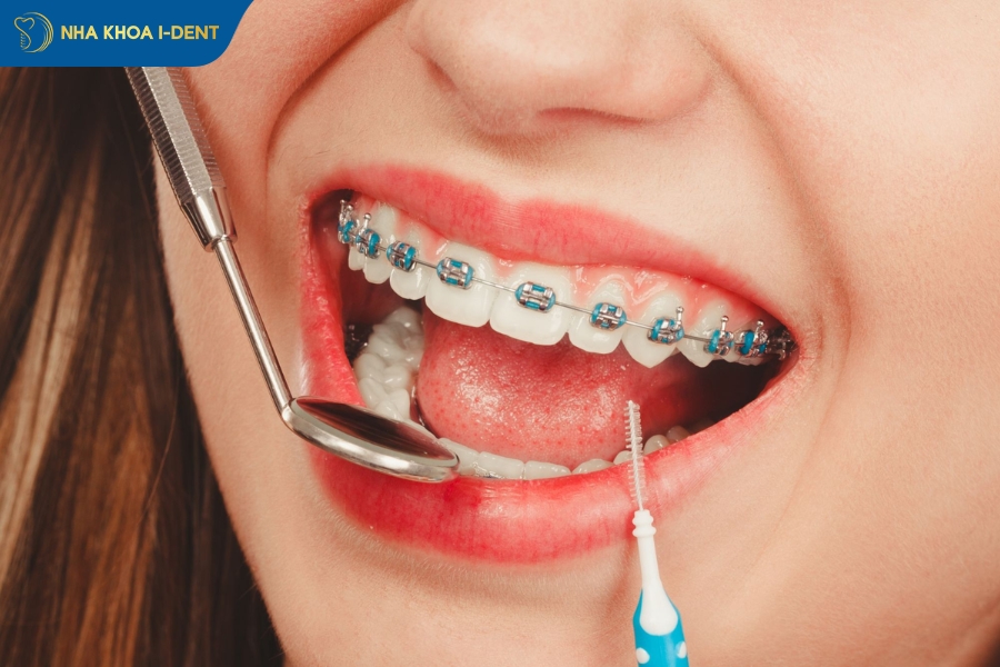 Cần phân tích mô mềm để biết niềng răng không nhổ răng được không