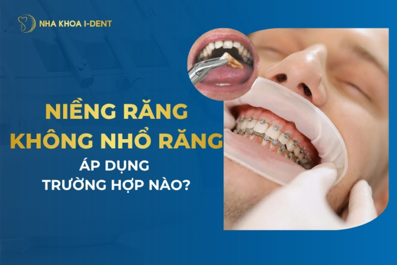 Niềng răng không nhổ răng được không? Ai không cần nhổ?