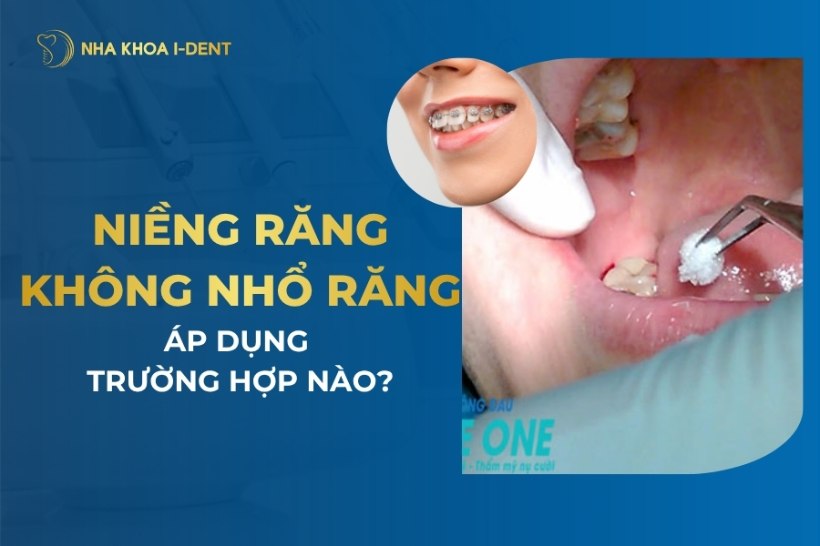 Niềng răng không nhổ áp dụng trong trường hợp nào?