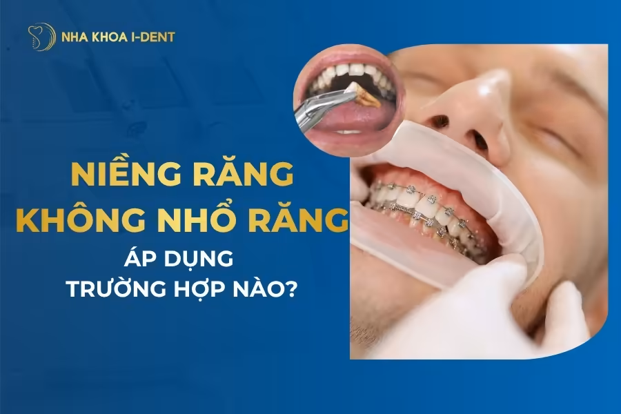 niềng răng không nhổ răng có hiệu quả không