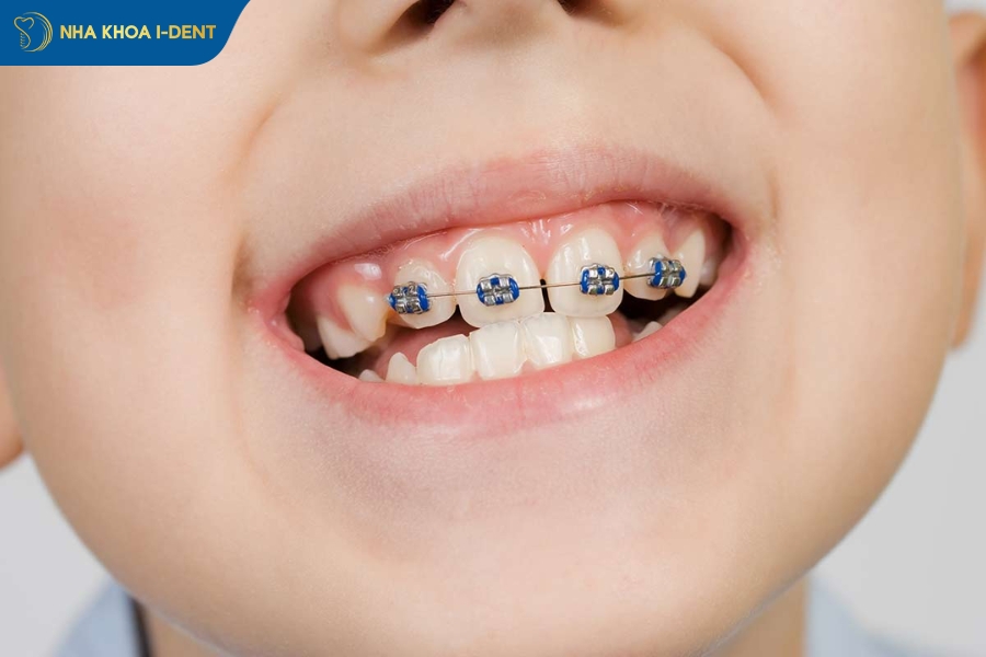 Trường hợp có răng lệch lạc nhẹ thì có thể sử dụng phương pháp xẻ kẽ thay cho nhổ răng