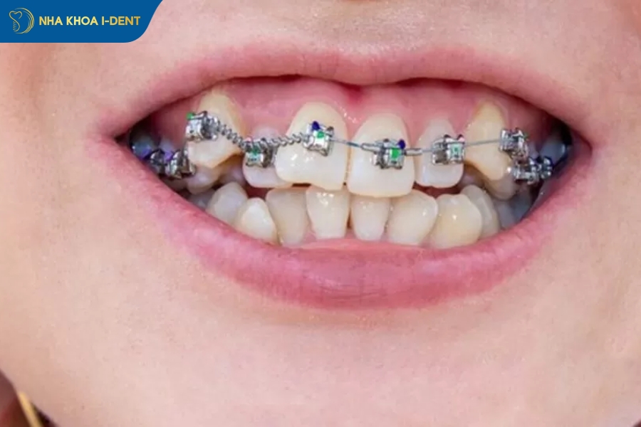 Niềng răng cho trẻ em (10-17 tuổi) hầu hết không cần nhổ răng