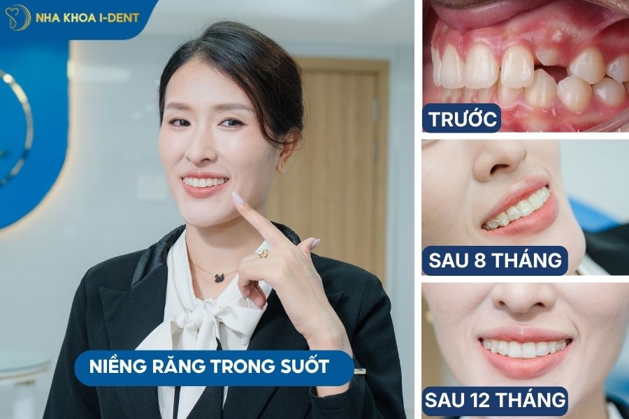 niềng răng khớp cắn sâu bằng khay niềng