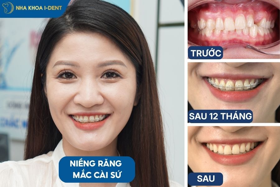 niềng răng khớp cắn sâu bằng mắc cài sứ