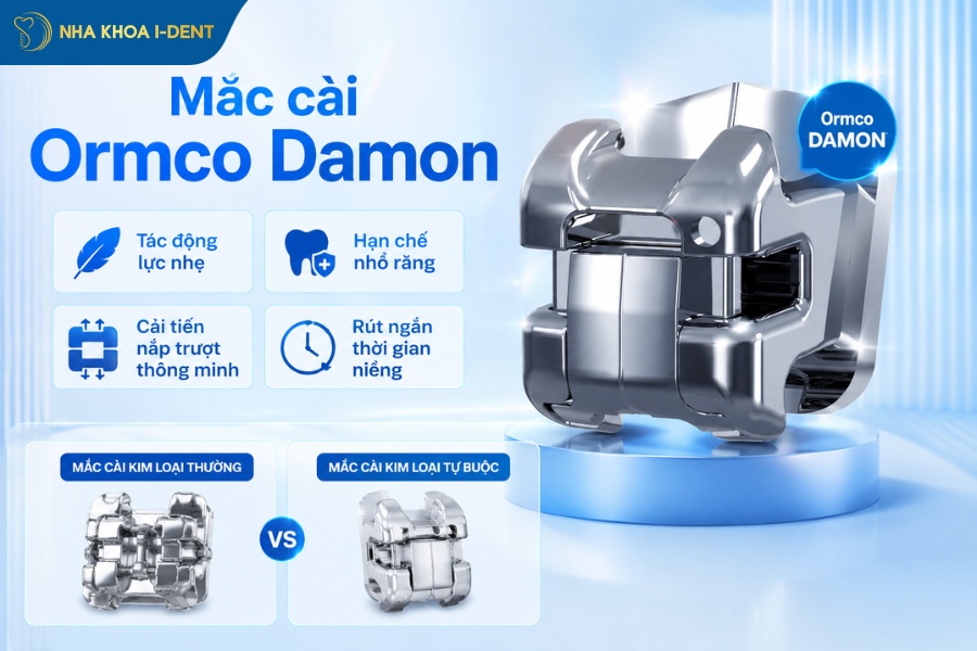niềng răng kim loại giá bao nhiêu