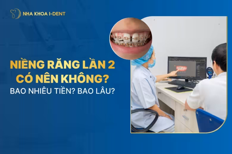 Niềng răng lần 2 có nên không? Bao nhiêu tiền? Bao lâu?