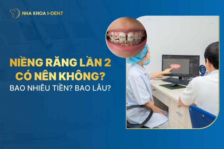 Có nên niềng răng lần 2 không? Chi phí và thời gian