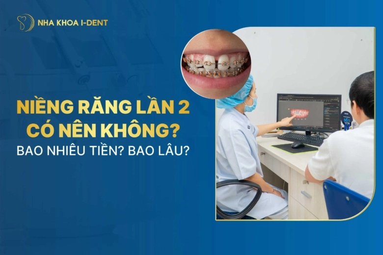 Niềng răng lần 2 có nên không? Bao nhiêu tiền? Bao lâu?
