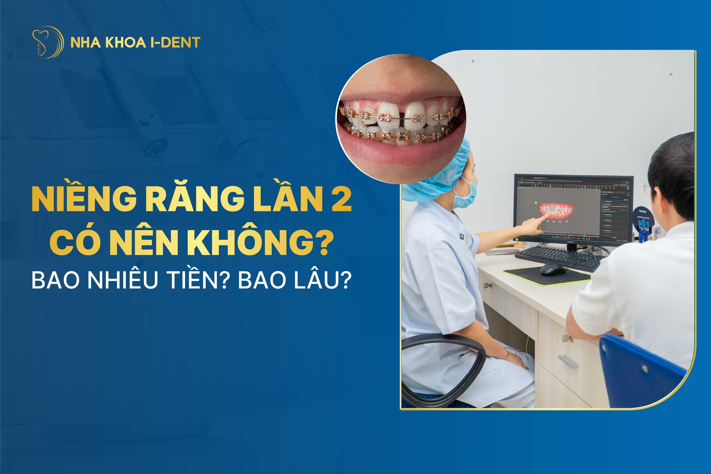 Có nên niềng răng lần 2 không? Chi phí và thời gian