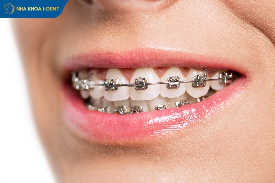 niềng răng lệch khớp cắn bao nhiêu tiền - Nha khoa I-Dent