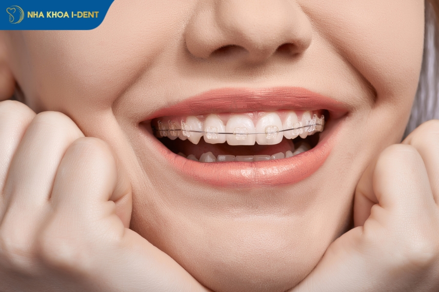 niềng răng lệch khớp cắn bao lâu - Nha khoa I-Dent