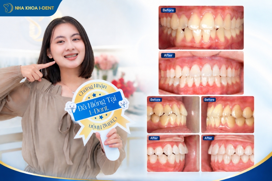 niềng răng lệch khớp cắn - Nha khoa I-Dent
