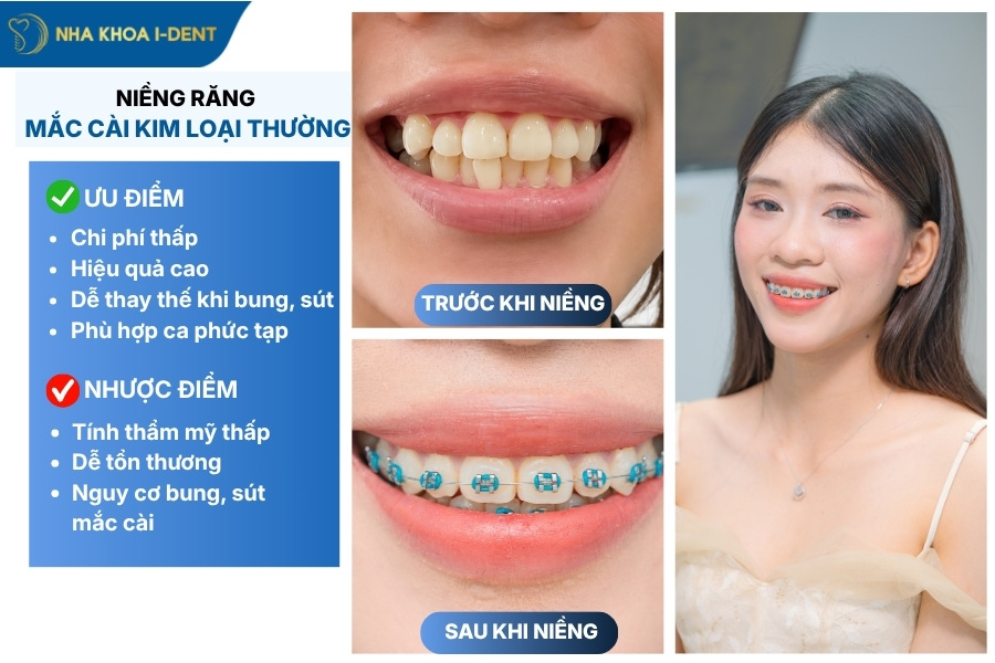 niềng răng mắc cài