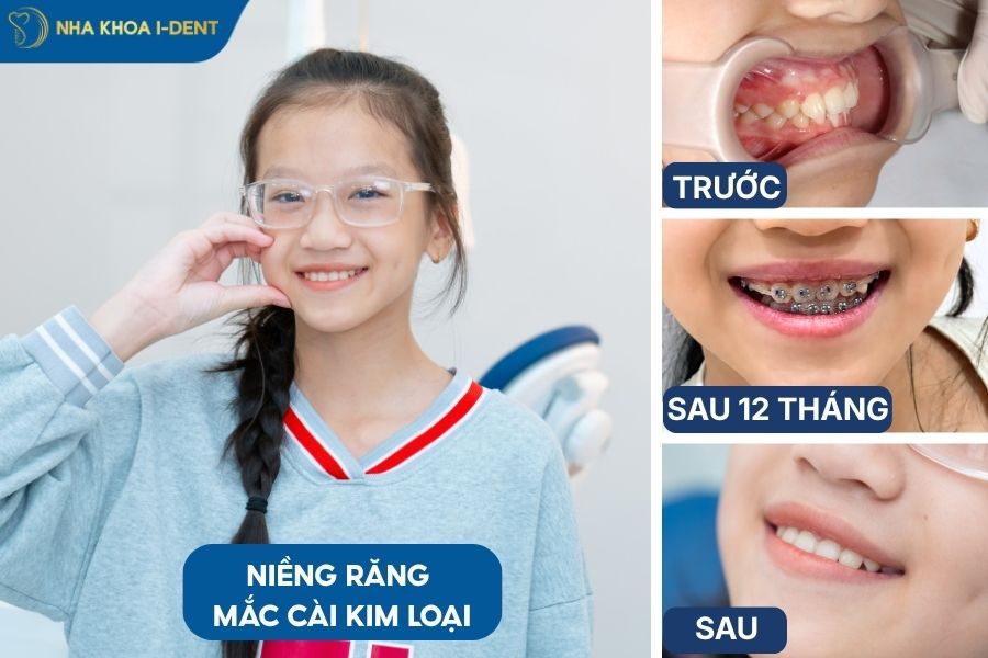 Kết quả trước và sau khi niềng răng mắc cài