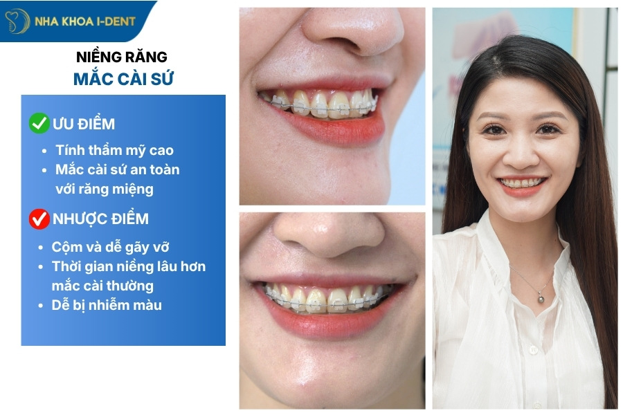 niềng răng mắc cài là gì