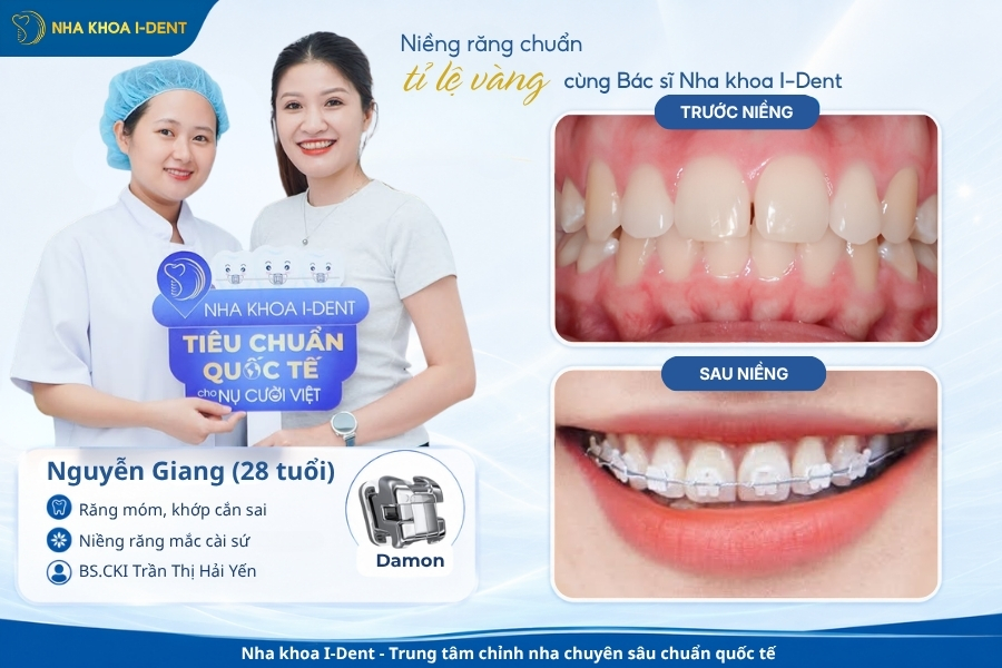 Phương pháp niềng răng mắc cài sứ có tính thẩm mỹ hơn nên giá sẽ cao hơn