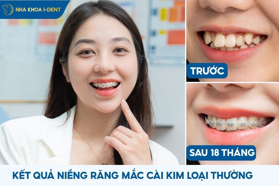mắc cài niềng răng