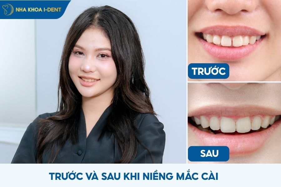 mắc cài niềng răng