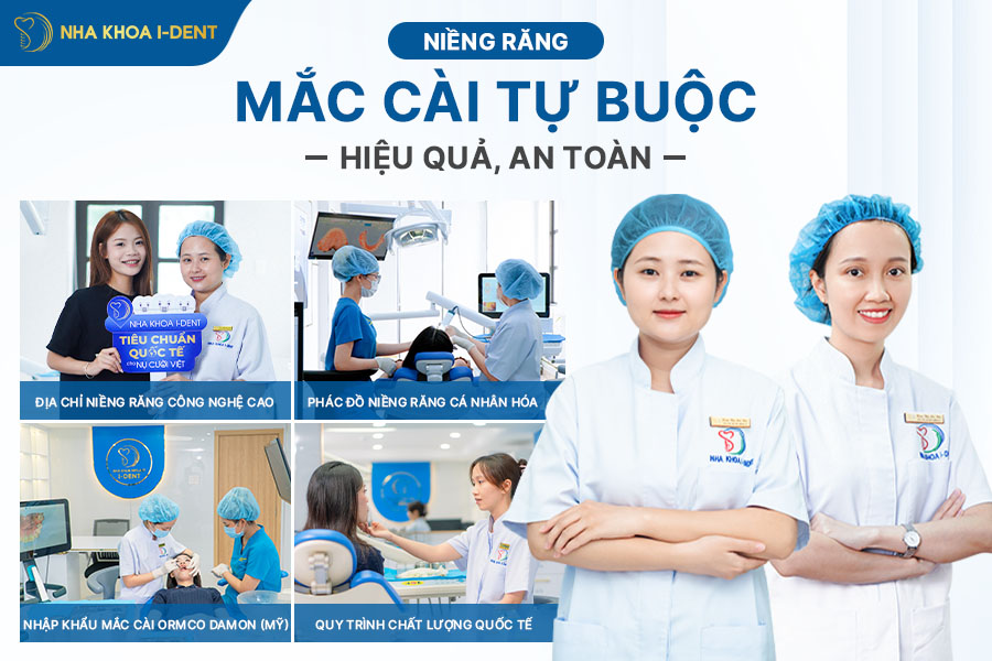 niềng răng mắc cài tự buộc là gì