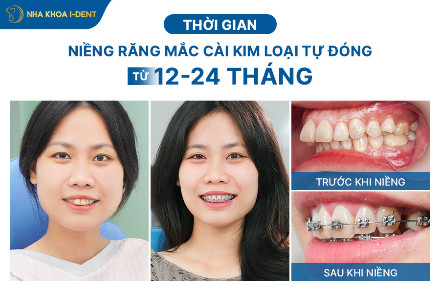 niềng răng tự buộc
