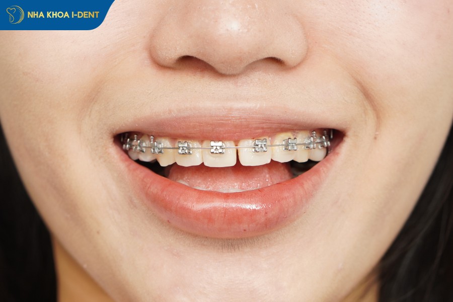 niềng răng mắc cài tự đóng giá bao nhiêu
