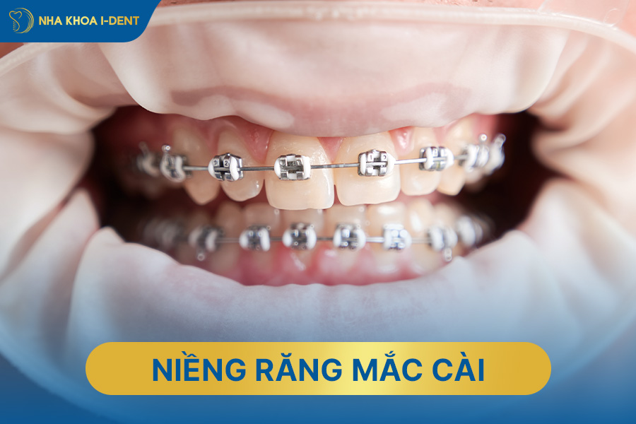 niềng răng trong suốt và niềng răng mắc cài