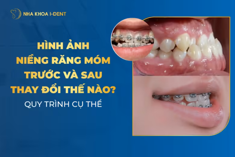 niềng răng móm trước và sau