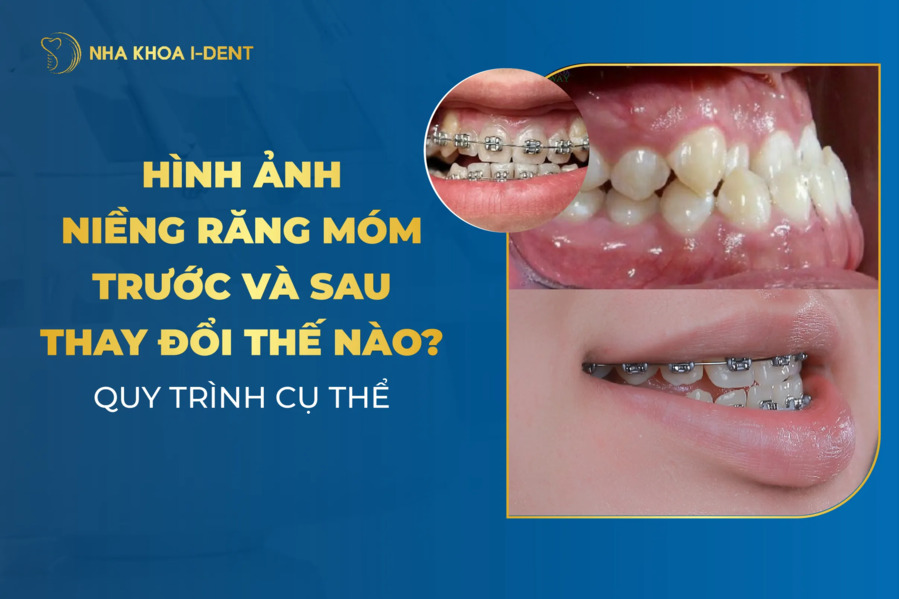 Niềng răng móm trước và sau thay đổi thế nào? Quy trình cụ thể